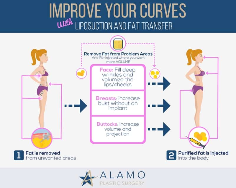 Fat Transfer as an Alternative to Implants — Her Culture